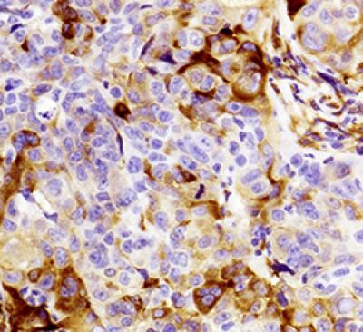 When lung cancer cells become drug resistant, tumor cells return as shown in brown. (Image: UC San Diego School of Medicine) When lung cancer cells become drug resistant, tumor cells return as shown in brown. (Image: UC San Diego School of Medicine)