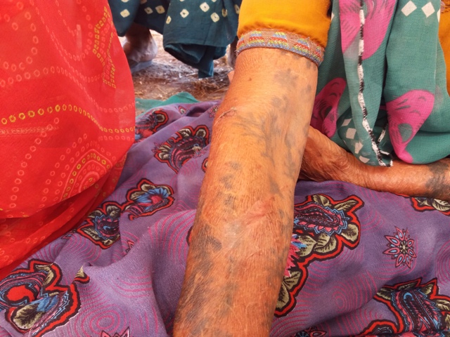 Kamlaben Makwana still carries the scars from the beating by police in February. Photo credit: Aarefa Johari Kamlaben Makwana still carries the scars from the beating by police in February. Photo credit: Aarefa Johari