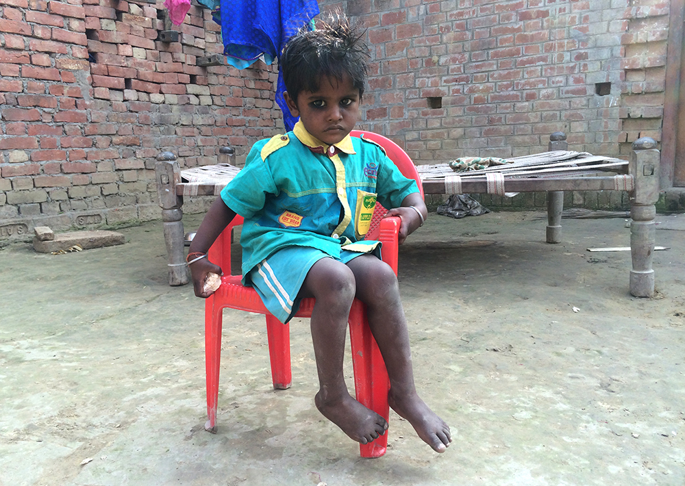 Rakesh Prajapati’s three-year-old son looks underweight. Rakesh Prajapati’s three-year-old son looks underweight.