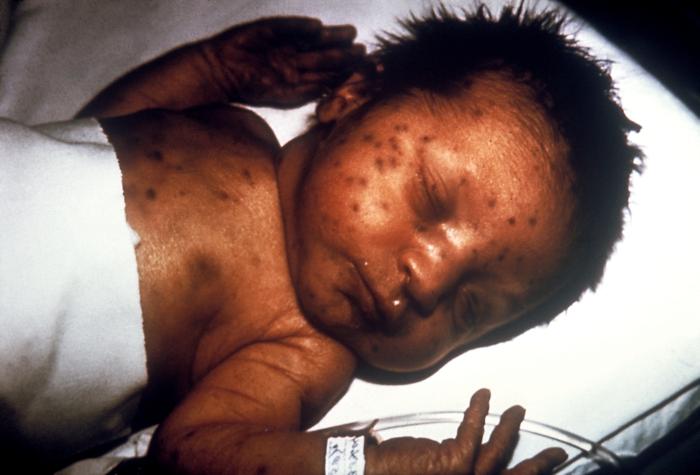 Infant with skin lesions from congenital rubella. (Photo: CDC/Wikimedia Commons) Infant with skin lesions from congenital rubella. (Photo: CDC/Wikimedia Commons)
