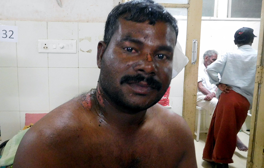 Alban Alphones from Poonthura fishing village spent two days in the sea after his boat was capsized in Cyclone Ockhi. He is under treatment at Government General Hospital at Thiruvananthapuram. Photo credit: TA Ameerudheen Alban Alphones from Poonthura fishing village spent two days in the sea after his boat was capsized in Cyclone Ockhi. He is under treatment at Government General Hospital at Thiruvananthapuram. Photo credit: TA Ameerudheen