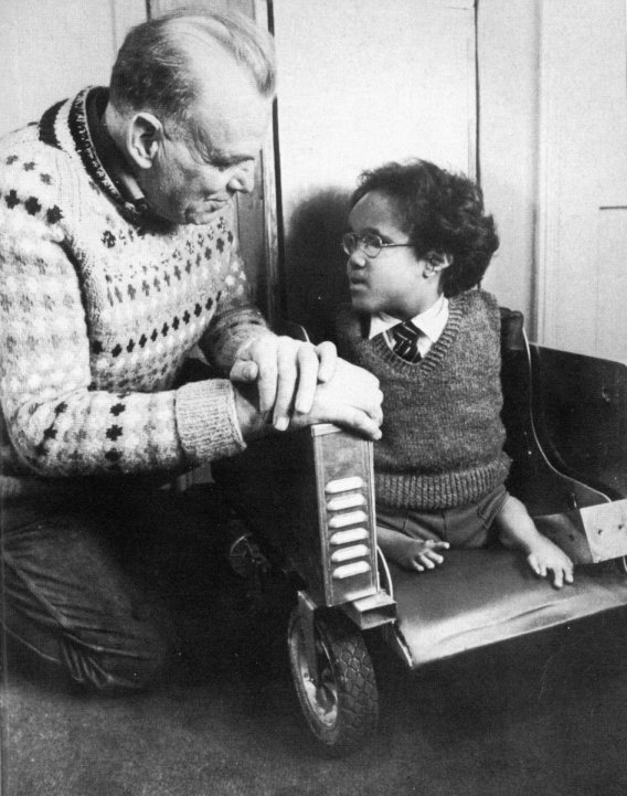 Photograph of Terry Wiles (right) who was born in 1962 with phocomelia, a condition in with ones in the arms and legs may be shortened or even absent, due to thalidomide. (Photo: Wikimedia Commons) Photograph of Terry Wiles (right) who was born in 1962 with phocomelia, a condition in with ones in the arms and legs may be shortened or even absent, due to thalidomide. (Photo: Wikimedia Commons)