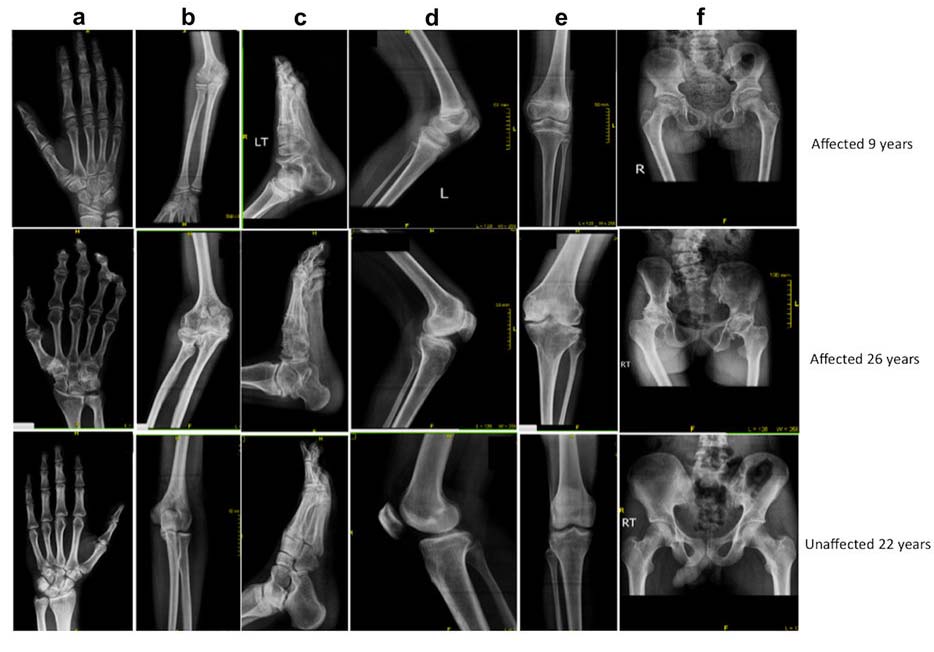 Representative radiographs of affected from both families. (Image: Whole Exome Screening Identifies Novel and Recurrent WISP3 Mutations Causing Progressive Pseudorheumatoid Dysplasia in Jammu and Kashmir, India) Representative radiographs of affected from both families. (Image: Whole Exome Screening Identifies Novel and Recurrent WISP3 Mutations Causing Progressive Pseudorheumatoid Dysplasia in Jammu and Kashmir, India)