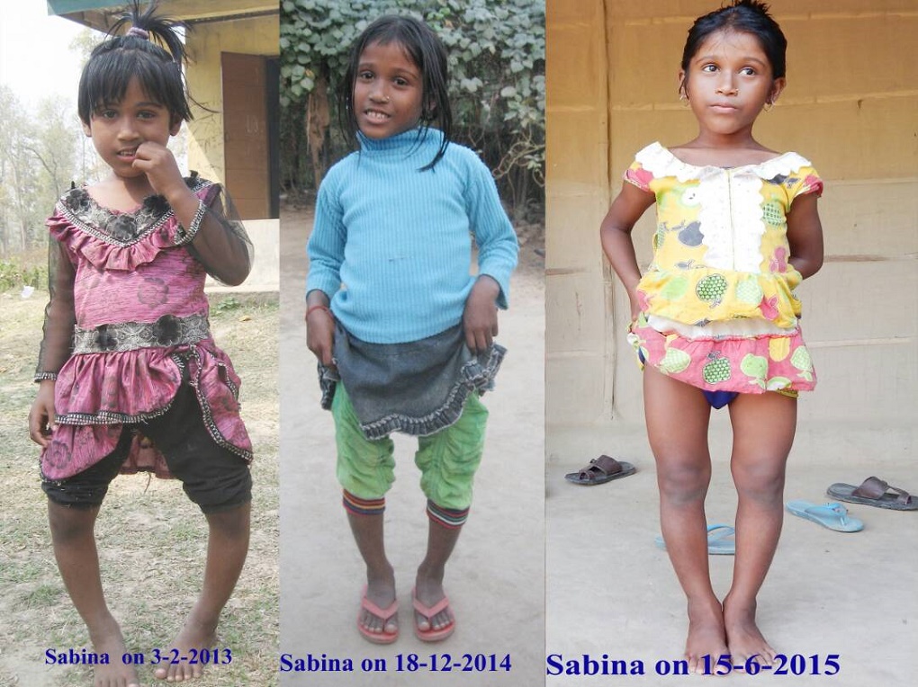 Sabina has slowly recovered from the effects of fluorosis after treatment. (Credit: Dhahran Saikia) Sabina has slowly recovered from the effects of fluorosis after treatment. (Credit: Dhahran Saikia)