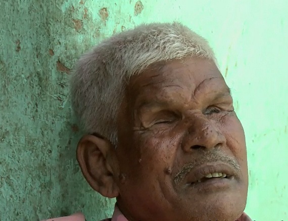 Bhola Chaudhary, who was blinded by the police in Bhagalpur. Bhola Chaudhary, who was blinded by the police in Bhagalpur.