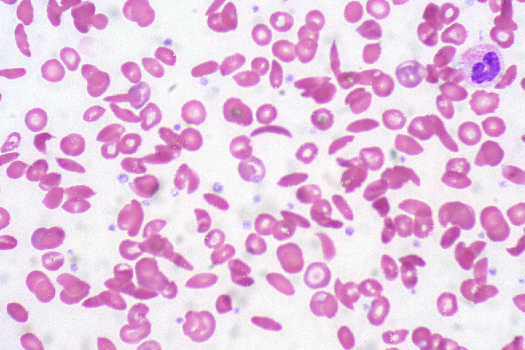 Sickle cell anemia is a mutation in response to malaria infections where red blood cells assume an abnormal rigid sickle shape. (Image: Ed Uthman/Flickr) Sickle cell anemia is a mutation in response to malaria infections where red blood cells assume an abnormal rigid sickle shape. (Image: Ed Uthman/Flickr)