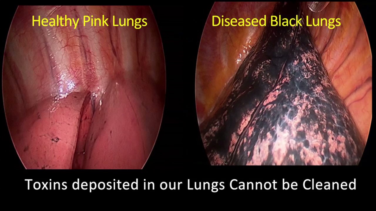 Dr Arvind Kumar's patient who is a non smoker had black sports in his lungs. Dr Arvind Kumar's patient who is a non smoker had black sports in his lungs.