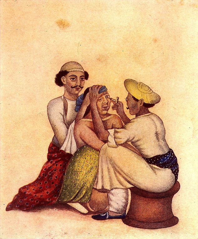 Couching for cataract. Credit: via Wellcome Images/Wikimedia Commons/CC BY 4.0 Couching for cataract. Credit: via Wellcome Images/Wikimedia Commons/CC BY 4.0