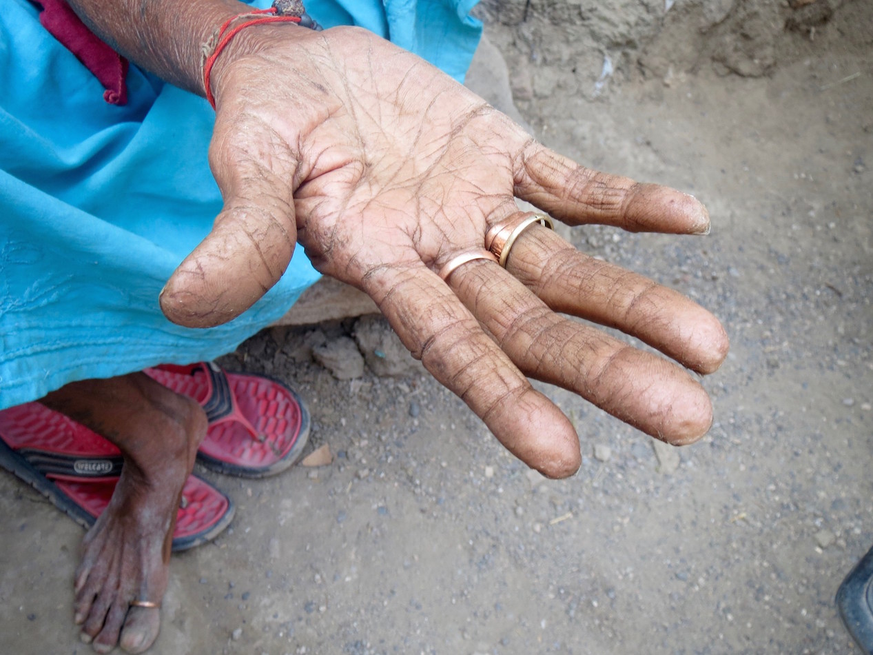 An old woman in Gujarat showed the cracked skin of her palms. Photo credit: Anumeha Yadav An old woman in Gujarat showed the cracked skin of her palms. Photo credit: Anumeha Yadav